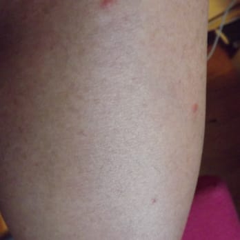 Norwegian Cruise Line - New York, NY, United States. Bedbug bites from ... Norwegian Cruise Line - New York, NY, United States. Bedbug bites from ...