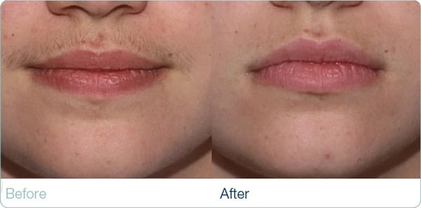 Before and after upper lip. | Yelp