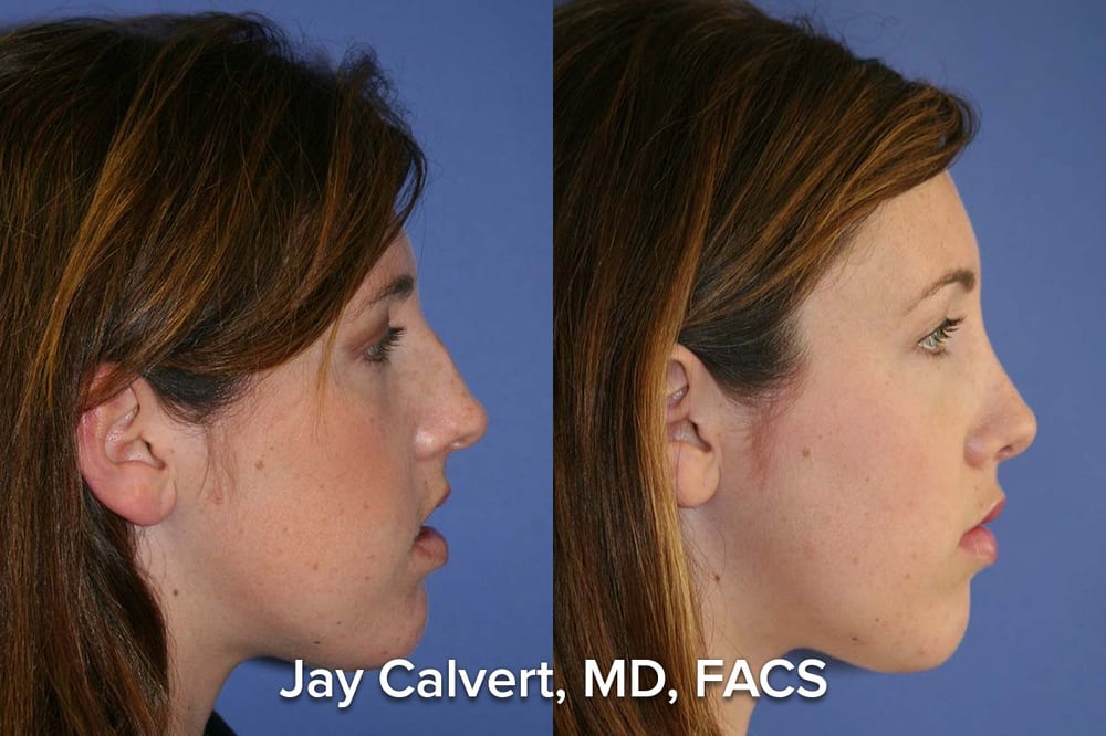 dr jay calvert primary rhinoplasty for hump and deviated jay calvert md