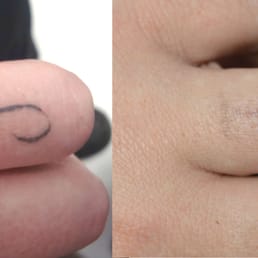 tattoo removal canada closed 19 photos tattoo removal 4300 tattoo removal canada closed 19 photos tattoo removal 4300