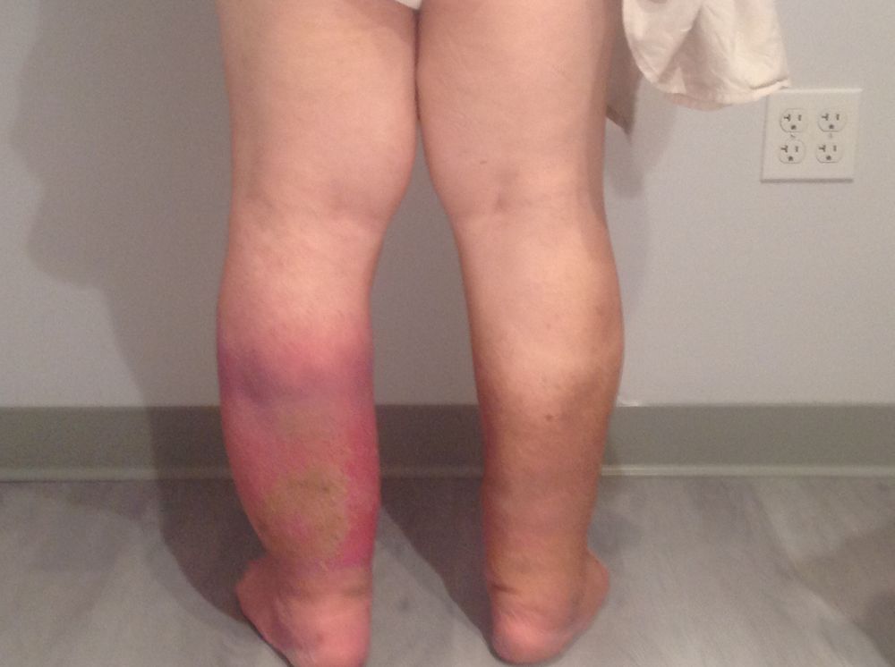 Lymphatic Therapy Services