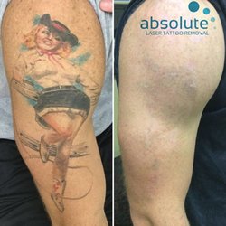 Photo Of Absolute Laser Tattoo Removal Sango Ca United States Color Photo Of Absolute Laser Tattoo Removal Sango Ca United States Color