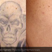 Photo Of Phoenix Tattoo Removal And Skin Revitalization Phoenix Az United States Photo Of Phoenix Tattoo Removal And Skin Revitalization Phoenix Az United States