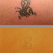 tattoo removal shop mn best tattoo 2017 tattoo removal shop mn best tattoo 2017