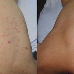 precision laser therapy 11 photos laser hair removal 275 old precision laser therapy 11 photos laser hair removal 275 old
