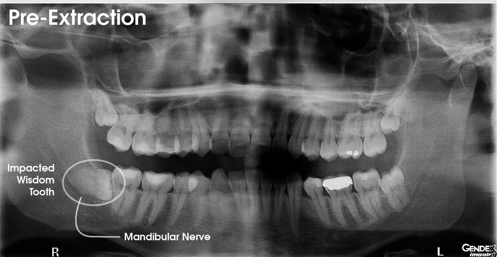 Impacted Wisdom Teeth Panoramic X Ray - TeethWalls