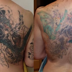 Photo Of Fade Fast Tattoo Removal Dallas Tx United States Removal Photo Of Fade Fast Tattoo Removal Dallas Tx United States Removal