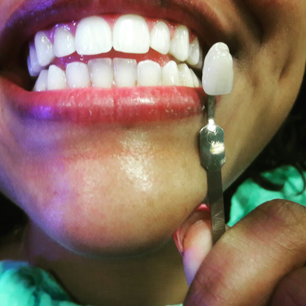 Radiant White Smiles of Austin 38 Photos Teeth Whitening 3801 N