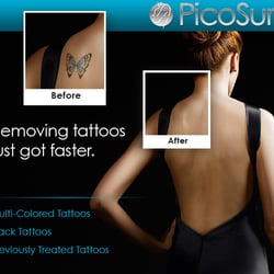 blink tattoo removal 10 photos u0026 13 reviews tattoo removal blink tattoo removal 10 photos u0026 13 reviews tattoo removal