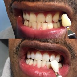 Image result for Teeth Whitening