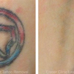 eraser clinic laser tattoo removal 76 photos u0026 42 reviews eraser clinic laser tattoo removal 76 photos u0026 42 reviews