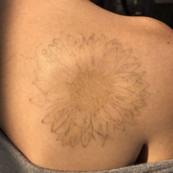 erased laser tattoo removal 65 photos u0026 57 reviews tattoo erased laser tattoo removal 65 photos u0026 57 reviews tattoo