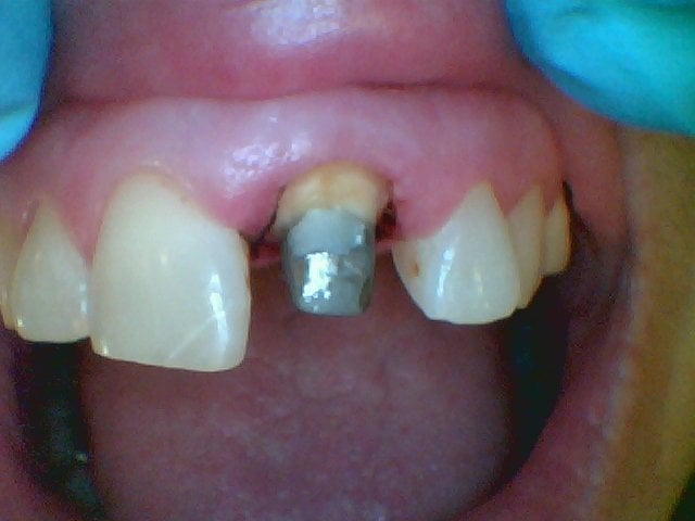 cast post and core