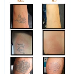 removing barriers tattoo removal 18 photos u0026 35 reviews tattoo removing barriers tattoo removal 18 photos u0026 35 reviews tattoo