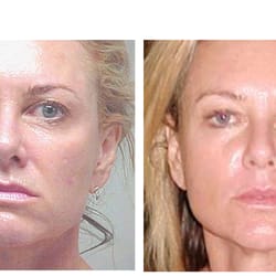 Excellent answer micro current facial sculpting Join told micro current facial sculpting very pity