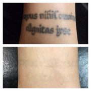 premium tattoo removal tattoo removal 3033 chimney rock rd premium tattoo removal tattoo removal 3033 chimney rock rd