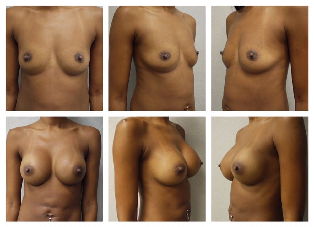 Augmentation breast financing virginia, fhm girls anal