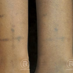 renewal laser clinic 37 photos u0026 23 reviews tattoo removal renewal laser clinic 37 photos u0026 23 reviews tattoo removal