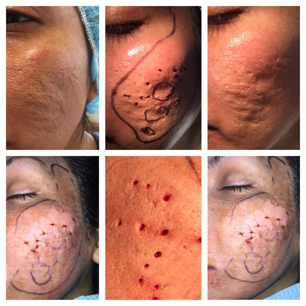 Home - Beauty Plus Aesthetics NYC punch excision and laser of ice pick scars - Yelp