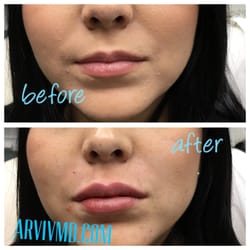mole removal vagina bradenton florida Mole removal vagina bradenton florida