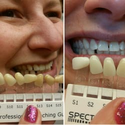 Smile Bar Teeth Whitening Reviews Creepingthyme Info Infinite Smile Cosmetic Teeth Whitening 28 Photos 34 Reviews