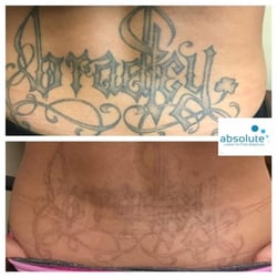 Photo De Absolute Laser Tattoo Removal Sango Ca Etats Unis Photo De Absolute Laser Tattoo Removal Sango Ca Etats Unis