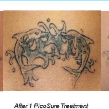 newport tattoo removal 31 photos u0026 11 reviews tattoo removal newport tattoo removal 31 photos u0026 11 reviews tattoo removal