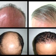 Neopel 66 Photos 16 Reviews Hair Loss Centers Jose Clemente Mexico Photo Of Neopel Tijuana Baja California