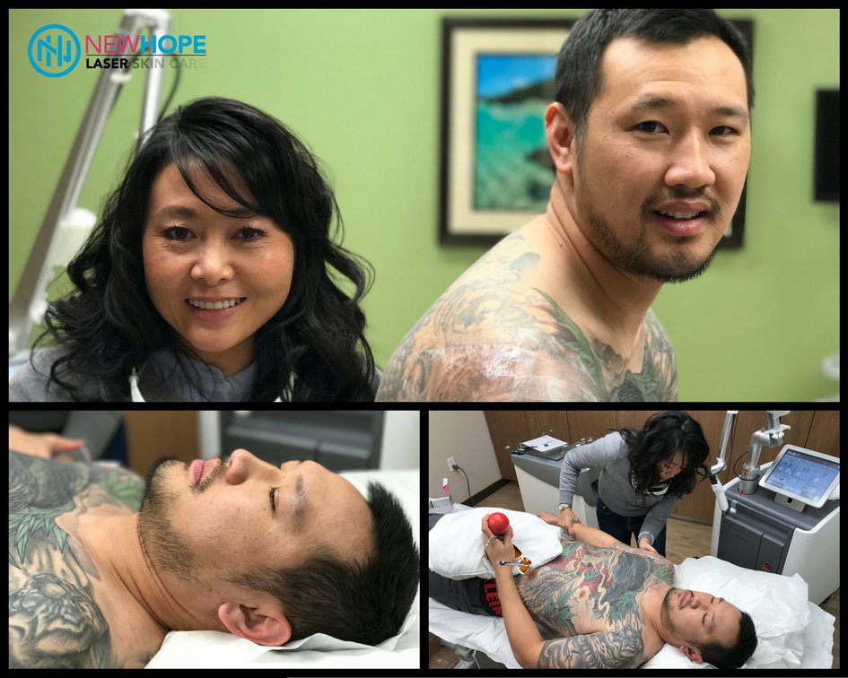 full sleeve laser tattoo removal yelp full sleeve laser tattoo removal yelp