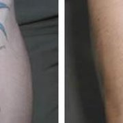 tattoo removal center 11 reviews dermatologists 347 5th ave tattoo removal center 11 reviews dermatologists 347 5th ave