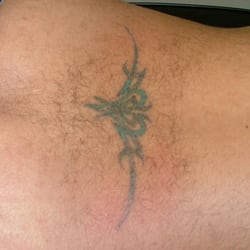 tat2 removers 14 reviews tattoo removal 2600 s lp w fwy tat2 removers 14 reviews tattoo removal 2600 s lp w fwy