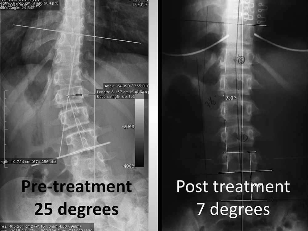 Non Surgical Scoliosis Treatment Yelp