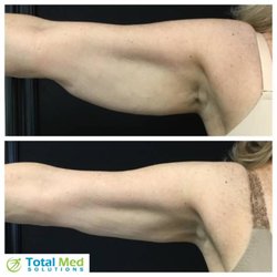 Hcg weight loss dallas tx
