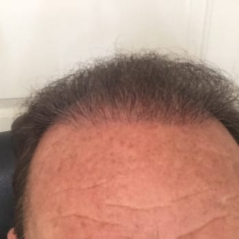 Neopel 64 Photos 16 Reviews Hair Loss Centers Jose Photo Of Neopel Tijuana Baja California Mexico 6 1 2 Months