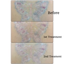 inkoff md 10 photos u0026 10 reviews tattoo removal 1585 inkoff md 10 photos u0026 10 reviews tattoo removal 1585