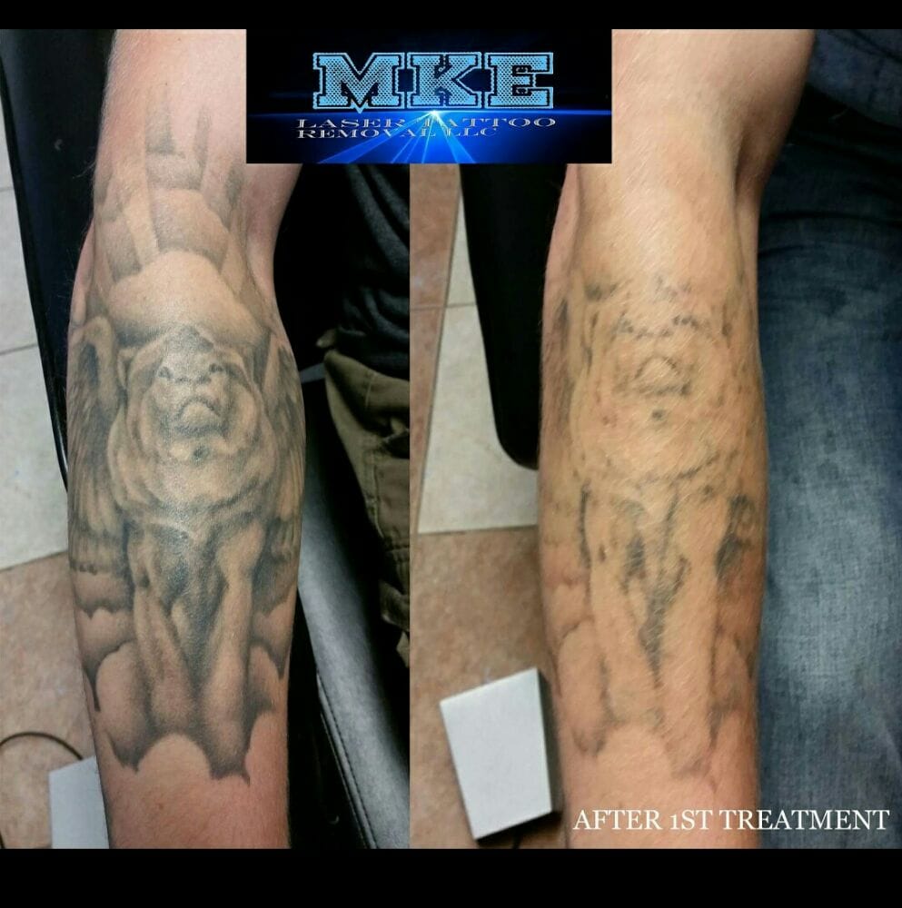 100 hindsight tattoo removal 24 photos tatts off a 100 hindsight tattoo removal 24 photos tatts off a