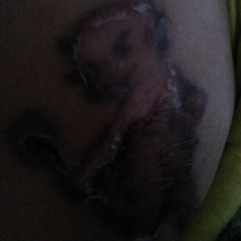 Absolute Laser Tattoo Removal - 45 Photos &amp; 49 Reviews 