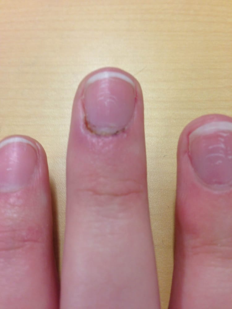 The Damage After Acrylic Nails That Lasted 1 Week And An Over Photo Of J Aime Nails Astoria Ny United States The Damage