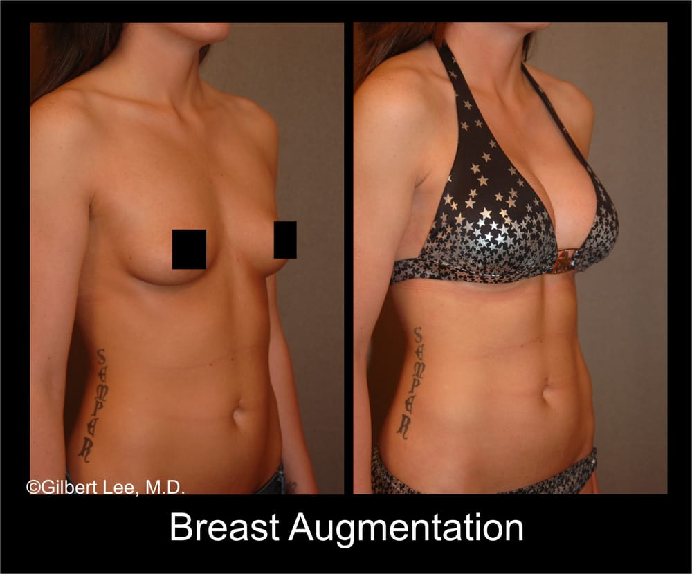 boobs blond oil breast implants in bel air maryland