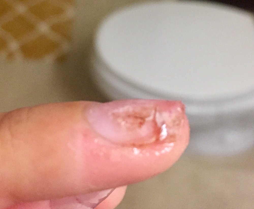My Damaged Nail Bed After Acrylic Removal Complete With Dried Photo Of Mangos Nails Spa Palo Alto Ca United States My