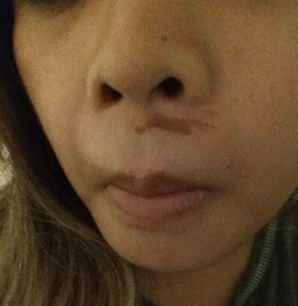 facial waxing burn Facial waxing burn