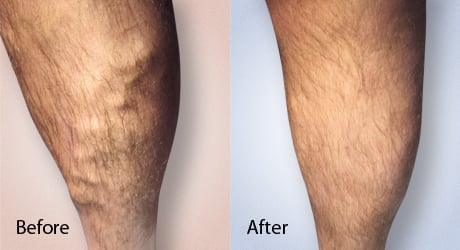 Spider vein removal deals nyc