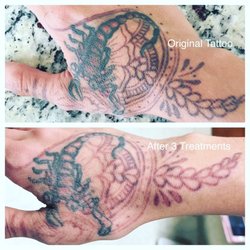 notatt tattoo removal tattoo removal 14540 victory blvd van notatt tattoo removal tattoo removal 14540 victory blvd van