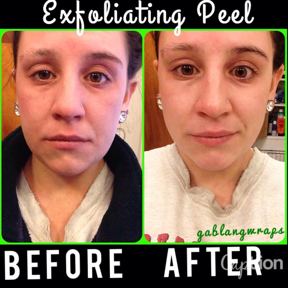 exfoliating peel from it works before and after yelp it works exfoliating peel before and after
