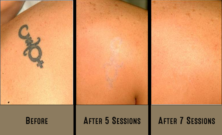 free my ink tattoo removal 3405 st claude ave st free my ink tattoo removal 3405 st claude ave st