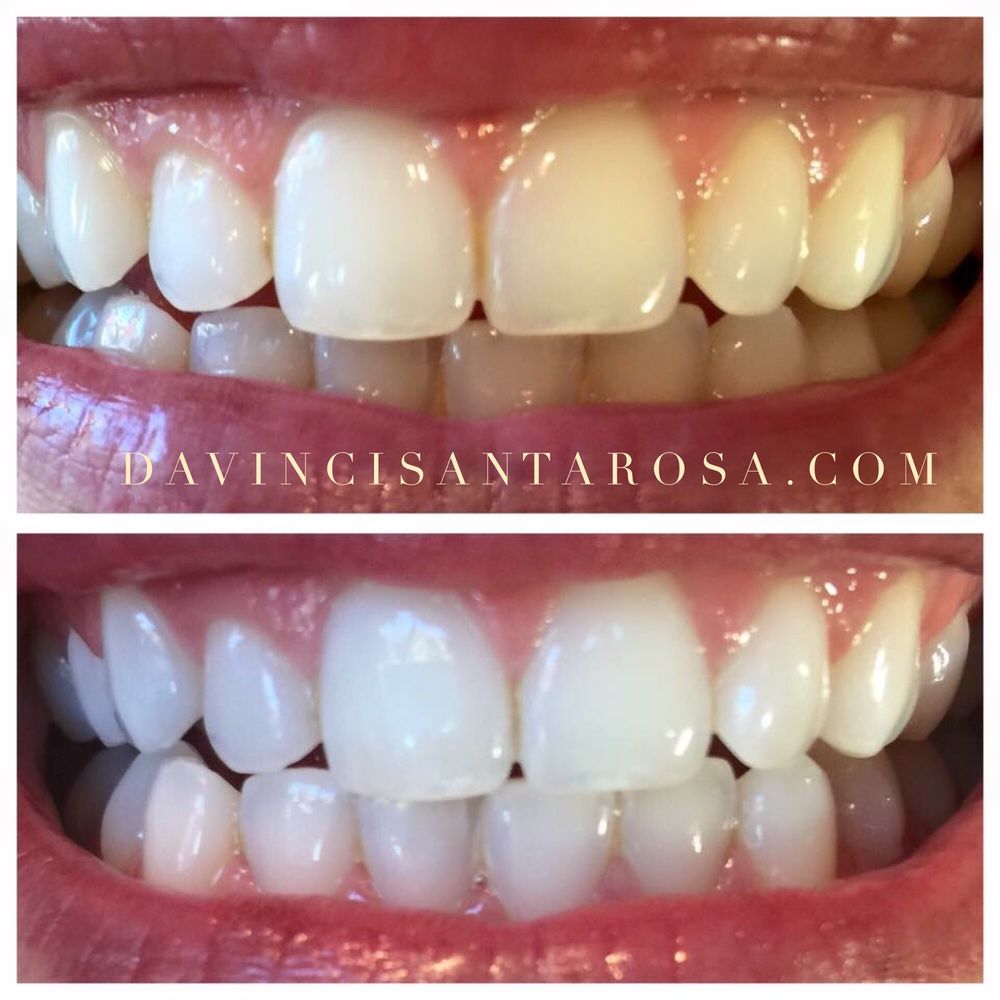 DaVinci Teeth Whitening Santa Rosa 36 Photos & 18 Reviews Teeth