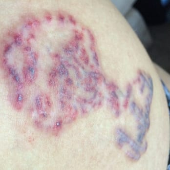 erased laser tattoo removal 65 photos u0026 57 reviews tattoo erased laser tattoo removal 65 photos u0026 57 reviews tattoo